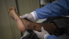 Vírus da varíola do macaco se mantém vivo em superfícies por mais de 20 dias