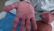 Novo padrão de sintomas da varíola do macaco inclui poucas lesões na pele e úlceras doloridas no ânus 