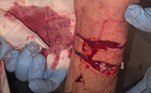 'Ele cortou minha artéria radial, [o que] exigiu uma cirurgia de emergência para consertar', escreveu o apanhador em postagem no Facebook