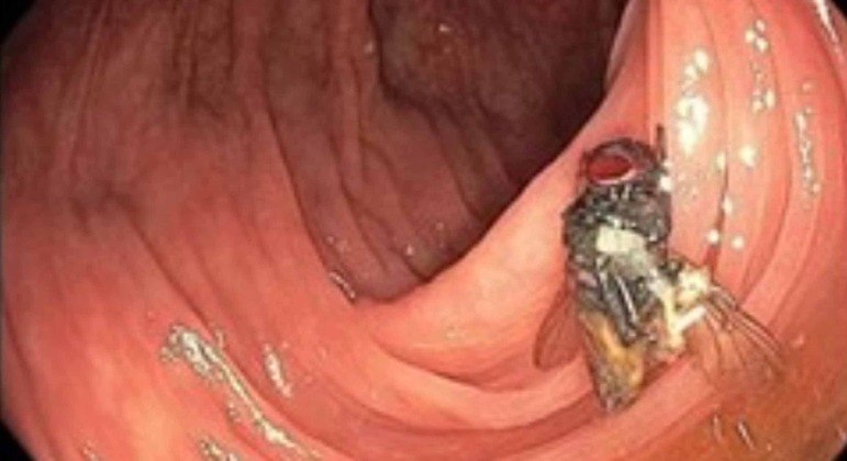 Médicos não sabem ao certo como a mosca foi parar no intestino do homem
