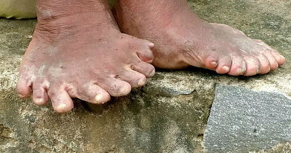 Mulher Que Nasceu Com 19 Dedos Nos Pes Nao Pode Sair De Casa Fotos R7 Hora 7