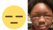 Jovem tem reação alérgica brutal a tintura de cabelo: 'Parecia que eu era um emoji'