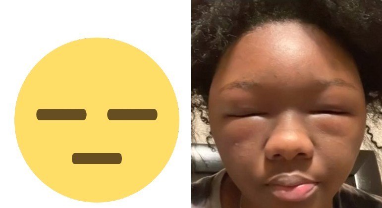 Shanika McNeil teve uma terrível reação alérgica a tintura de cabelo