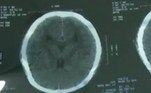 Atingida pela armação de ferro, a mulher imediatamente foi ao chão e teve que ser levada às pressas para o hospital, onde levou mais de 40 pontos na cabeça