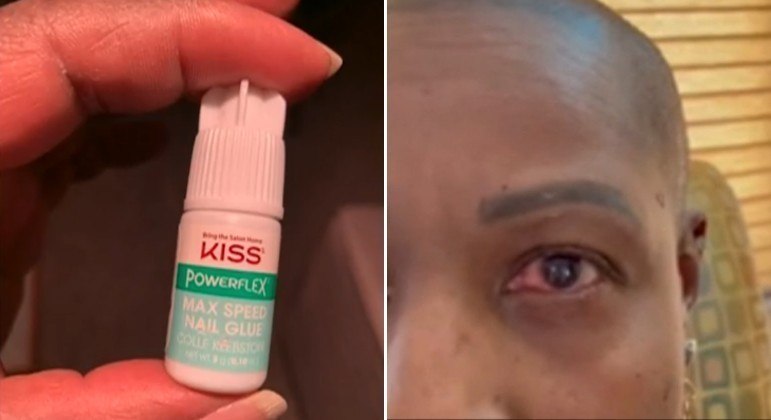Mulher pingou cola de unha em um dos olhos ao invés de colírio e acabou no hospital