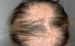 Foram muitos anos sofrendo com a condição, até então desconhecida. A Alopecia areata causa a perda de cabelo em várias partes do couro cabeludo, e impede os fios voltem a crescer naturalmente 