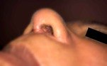 No nariz da vítima é possível identificar cicatrizes