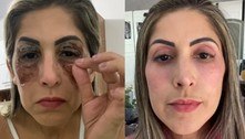 Mulher mostra rejuvenescimento do rosto 15 dias após fazer peeling de fenol e viraliza nas redes sociais