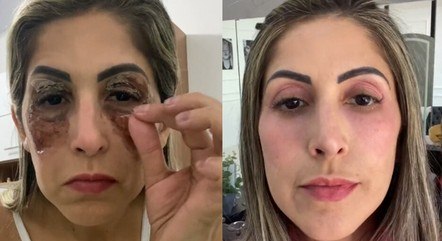 Mulher mostra rejuvenescimento do rosto 15 dias após fazer peeling de fenol  e viraliza nas redes sociais - Viva a Vida - R7 Beleza