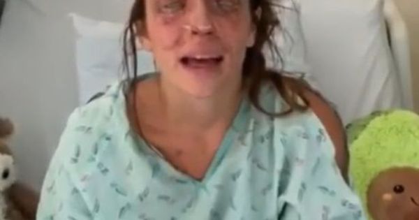 Mulher Fica Cega Apos Maquiagem Caseira Queimar Os Olhos Dela Fotos R7 Hora 7