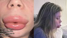 Mulher fica com 'boca de pato' após alergia a preenchimento labial 