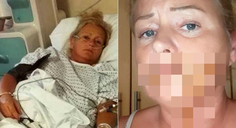 Britânica passou três dias no hospital após a chihuahua da filha ter defecado em sua boca