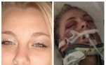 Kaylee Muthart, que arrancou seus próprios olhos aos 20 anos durante um episódio psicótico induzido por metanfetamina, recebeu um par de globos oculares protéticos