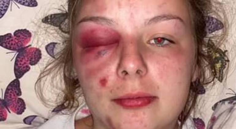 Jovem ficou assim após se bater com martelo