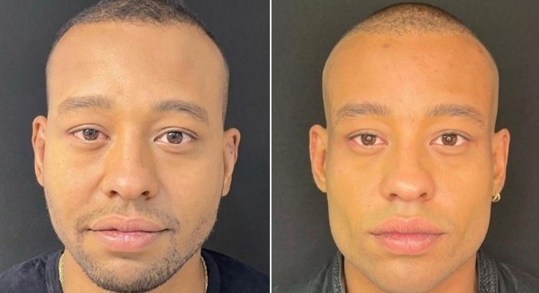 MussunzinhoO ator, de 29 anos, decidiu fazer o procedimento no fim de julho desde ano, após a final do reality show Power Couple Brasil 6, no qual ficou com a segunda colocação, ao lado da noiva, Karoline Menezes. As fotos de antes e depois de Mussunzinho encantaram Karol e também os seguidores do artista