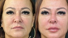 Mãe de Neymar, Nadine Gonçalves faz harmonização facial; compare o antes e o depois do tratamento