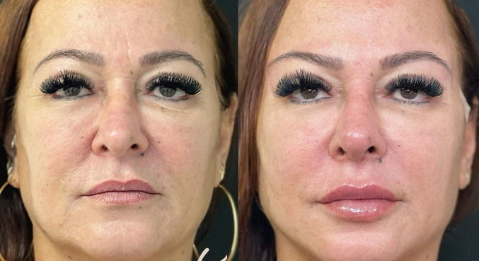 Fotos fazem a comparação de antes e depois do tratamento de Nadine
