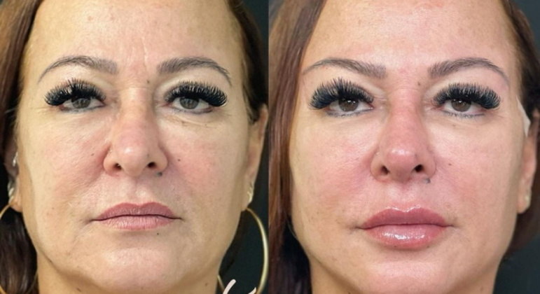 Nadine GonçalvesA influenciadora, de 55 anos, passou por harmonização em fevereiro deste ano. A mãe de Neymar fez tratamentos para suavizar a pele da região dos olhos, ao redor da boca e também para ficar com os lábios maiores