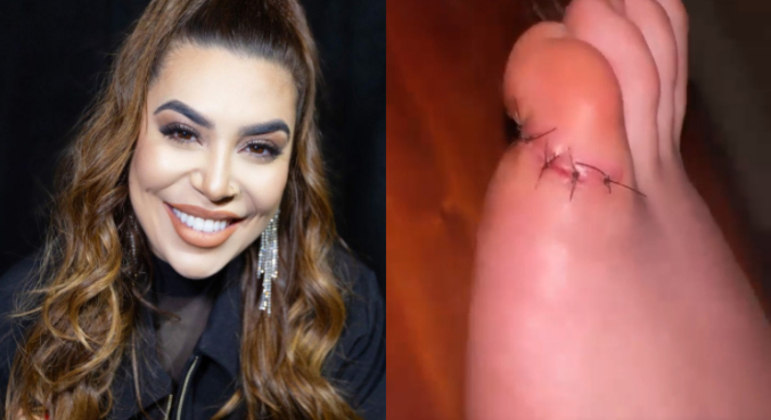 Naiara Azevedo levou cinco pontos no dedo do pé após acidente com faca