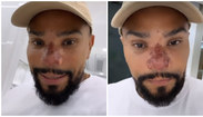 Naldo Benny aparece com nariz machucado após fazer rinomodelação (Fotos de Reprodução/Instagram)