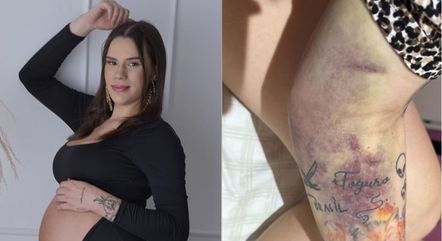 Nara Paraguaia mostra hematomas após complicações no parto