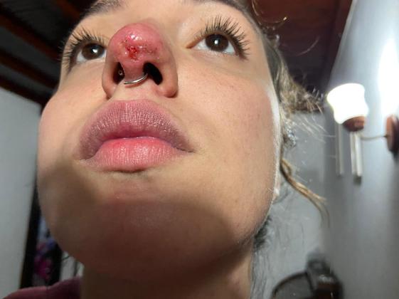 Louise está em contato com um advogado e busca o ressarcimento do valor de aproximadamente R$ 5.000 que gastou para reparar o nariz. O que a conforta é o fato de aquela luta incerta ter acabado. Ela declara como está: “Em paz sabendo que disso não vai passar, não vai ficar pior, e que a minha saúde está intacta”. Porém, inevitavelmente, as cicatrizes intensificaram o sentimento de insegurança que a jovem já tinha em relação ao nariz