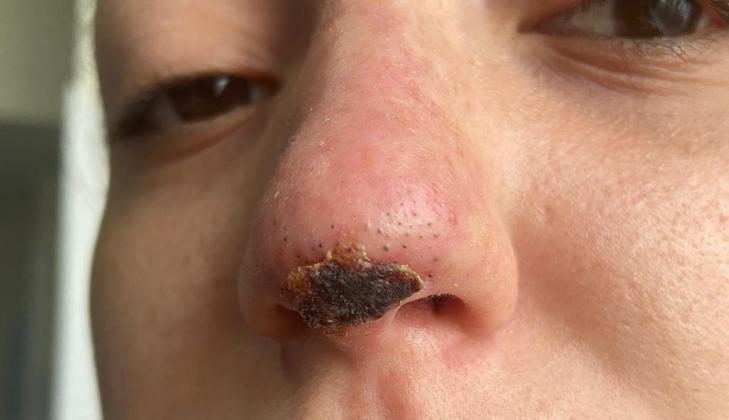 A jovem revela que sua vida virou de cabeça para baixo depois do imprevisto. Saiu do emprego antigo devido ao longo tempo afastada dele, se atrasou nos estudos e foi tomada pela frustração, principalmente ao ver que o profissional responsável por desestruturar a sua autoestima seguiu a vida normalmente e continua fazendo o procedimento em outras pessoas