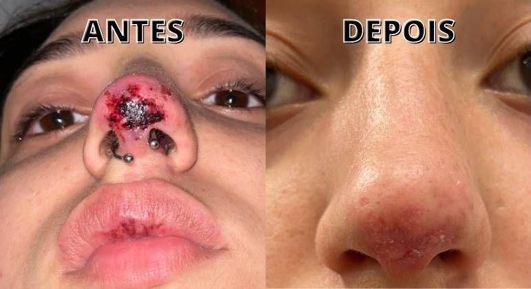 Dois meses após o início de um pesadelo, Louise Reynaud, de 22 anos, vê sua vida voltando a uma normalidade que ela jamais imaginava. Em maio, depois de passar por uma rinomodelação malsucedida, a jovem teve necrose na ponta do nariz e quase perdeu parte dele. Após dias angustiantes e diversos tratamentos, conseguiu reverter o quadro grave