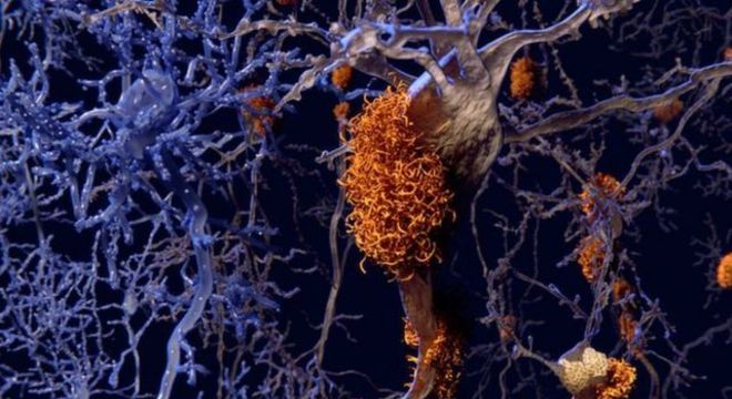 Pelo que se sabe até o momento, a doença se inicia com a deposição da proteína beta-amiloide (representada na cor laranja na ilustração) do lado de fora dos neurônios