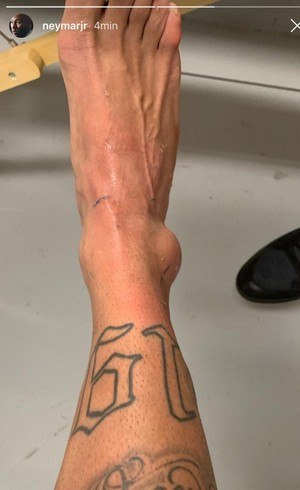 Assim estava o tornozelo de Neymar