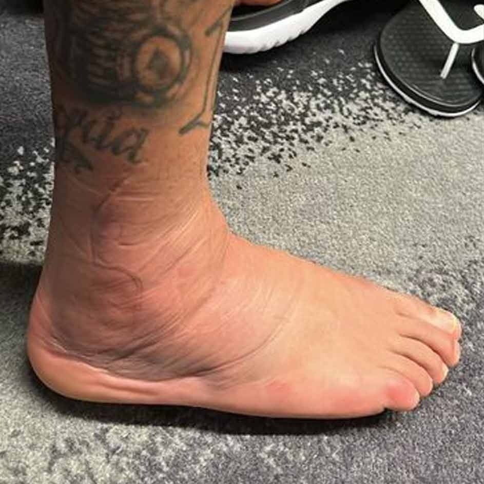 O tornozelo direito de Neymar ainda bastante inchado. A recuperação dos ligamentos não é simples