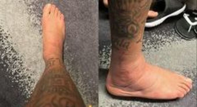 Neymar mostrou o tornozelo inchado nas redes sociais