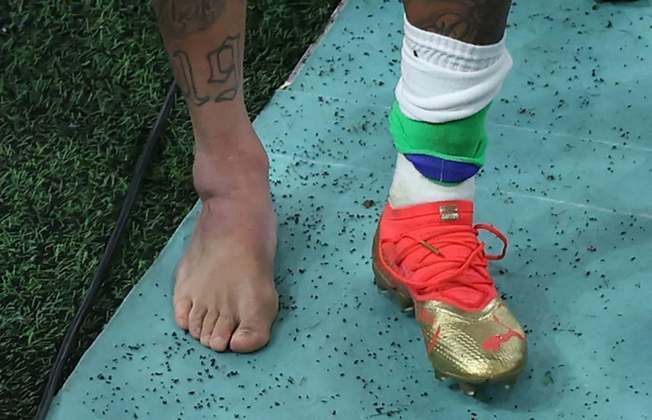No detalhe o tornozelo inchado de Neymar.