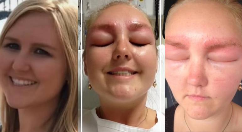 Tamika Cleggett ficou com o rosto deformado após uma reação alérgica grave