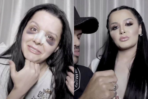 No início de 2020, Maiara colocou prótese de silicone nos seios e Maraisa chocou ao mostrar o rosto completamente roxo, resultado do pós-operatório de uma rinoplastia
