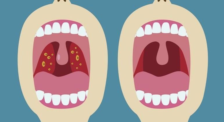 O Que é Adenoide? Sintomas E Quando é Necessário Removê-la