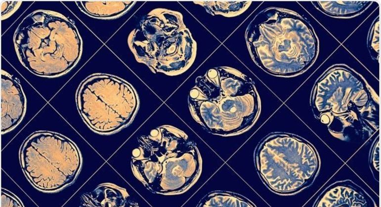 O que é esquizofrenia - tipos, sintomas, causas e formas de tratamento