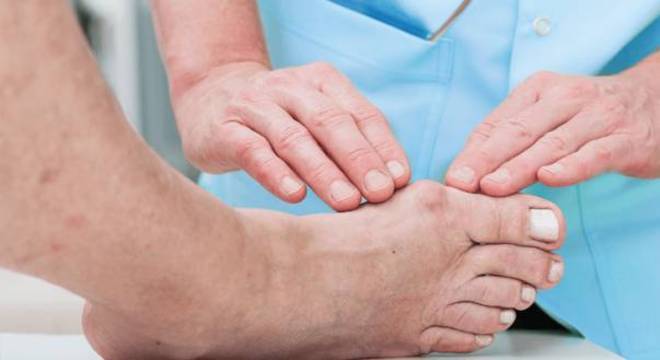 O que é Joanete (Hálux Valgo)? Sintomas, causas e tratamento