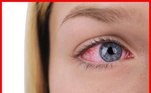 Caso o diagnóstico de alergia
ocular seja confirmado, evite esfregar os olhos ou lavá-los com soro fisiológico pois o sal do soro irrita ainda mais os olhos. Aplicar compressas frias sobre
os olhos fechados pode ajudar no desconforto, mas é preciso uma consulta ao
oftalmologista para tratamento adequado. Vale ressaltar que a alergia
ocular pode evoluir se não for tratada da maneira certa, trazendo algumas
complicações para a visão como úlceras, formação de placas e surgimento de
vasos anormais na periferia da córnea