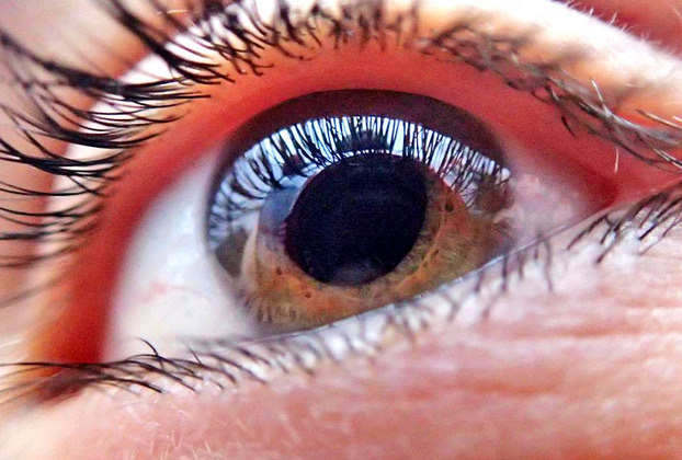 Os sintomas da visão dupla variam de acordo com a causa. Entre os principais sintomas estão dor no olho, olho saliente ou fraqueza muscular. 