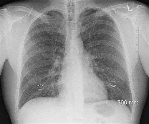 Os vírus respiratórios podem causar infecção aguda nos brônquios (bronquiolite) e nos pulmões (pneumonia).