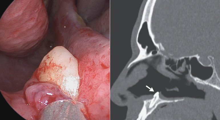 Paciente com problema respiratório teve dente retirado de dentro do nariz