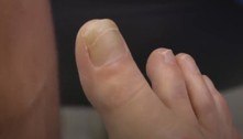Paciente com dedão do pé gigante surpreende médicos: 'Dói muito'