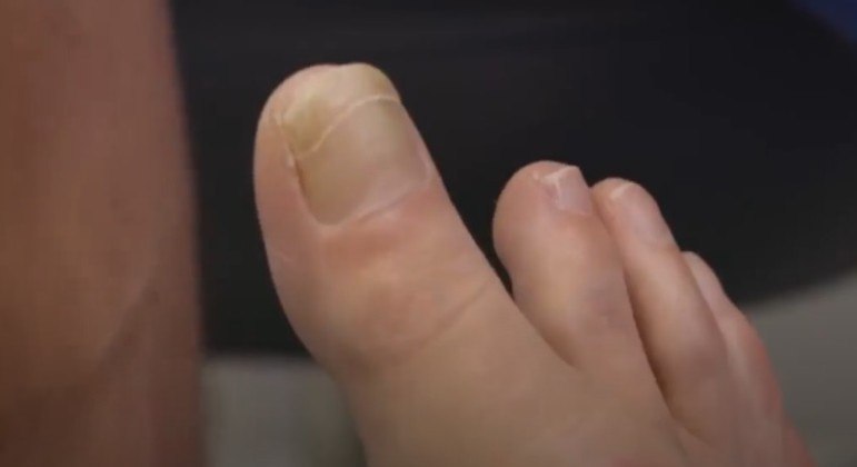 Paciente chocou cirurgião especializado em pés com um dedão extremamente longo e raro