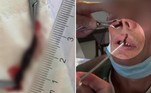 Um paciente teve uma sanguessuga viva retirada pelo nariz, em um hospital da cidade chinesa de Pu'er, ao sul do país asiático