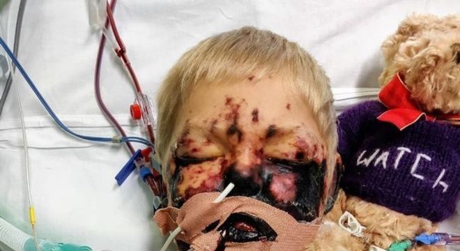 pais menino meningite alerta