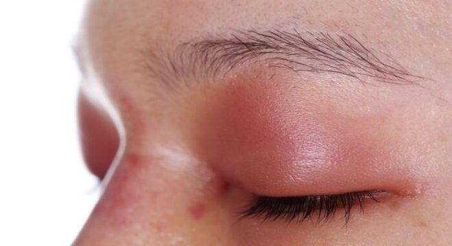 Pálpebras inchadas: causas e tratamento para inchaço ao redor dos olhos