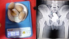 Passageiro é detido com quase 1 kg de ouro em pasta no reto 