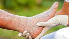 Cuidar dos pés é fundamental para diabéticos e pré-diabéticos. Veja como fazer
