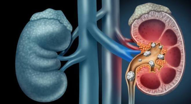 Pedra nos rins - Causas, sintomas e tratamentos para o cálculo renal